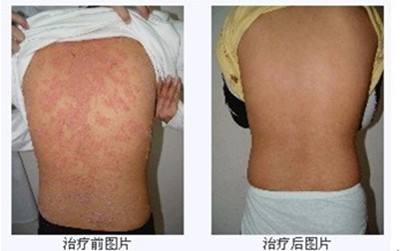 重庆皮肤病医院治疗牛皮癣_重庆皮肤科医院治疗牛皮癣