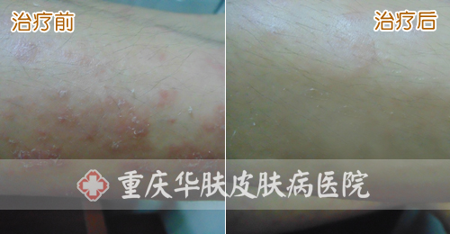 重庆皮肤病医院_皮肤科_预约挂号