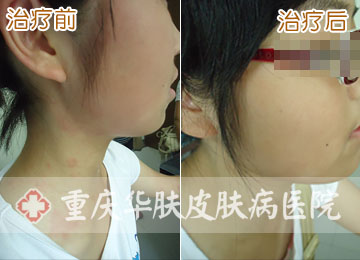 重庆皮肤病医院_皮肤科_预约挂号