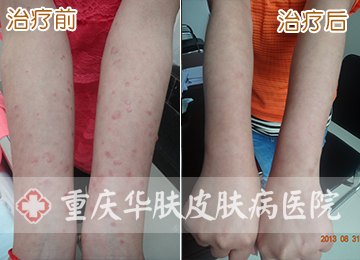 重庆皮肤病医院_皮肤科_预约挂号