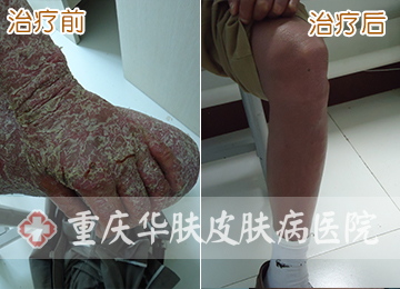重庆皮肤病医院_皮肤科_预约挂号