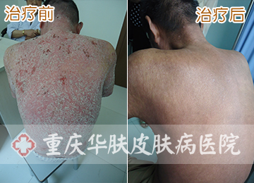 重庆皮肤病医院_皮肤科_预约挂号