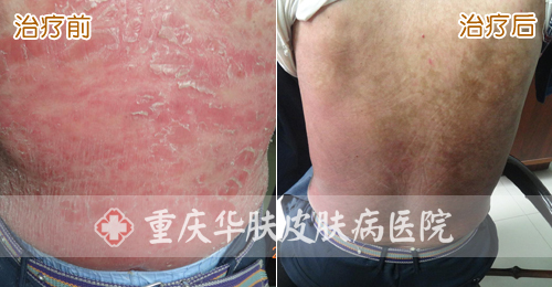 重庆皮肤病医院_皮肤科_预约挂号