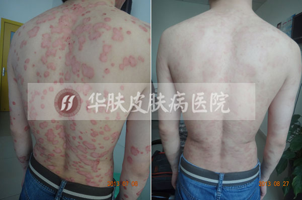 重庆皮肤病医院_皮肤科_预约挂号