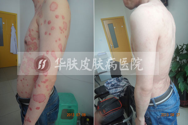 重庆皮肤病医院_皮肤科_预约挂号