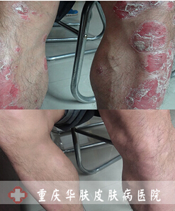 重庆皮肤病医院_皮肤科_预约挂号