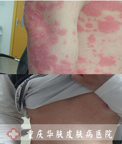 重庆皮肤病医院_皮肤科_预约挂号
