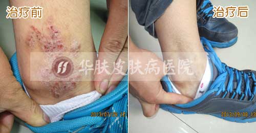 重庆皮肤病医院_皮肤科_预约挂号