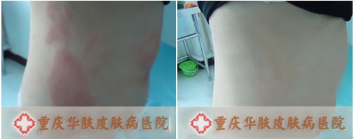 重庆华肤医院好吗[皮肤科]