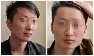 痤疮重庆华肤医院治疗怎么样