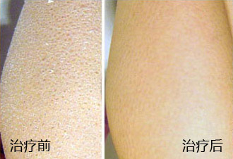 看鱼鳞病重庆华肤医院怎么样