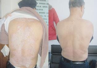 重庆市华肤医院治牛皮癣的专家[金铮]