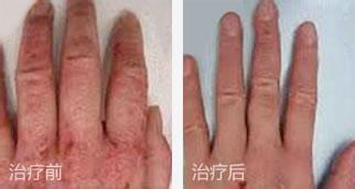 重庆市有没有专看湿疹的医院