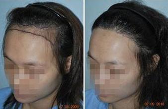 重庆皮肤科医院治疗脱发_脱发症状_脱发病因_脱发治疗案例效果图