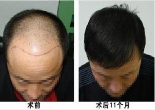 重庆皮肤科医院治疗脱发_脱发症状_脱发病因_脱发治疗案例效果图