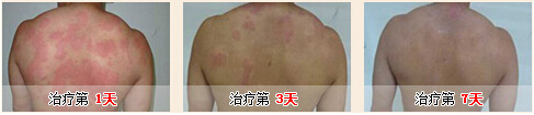 治疗荨麻疹的偏方有哪些