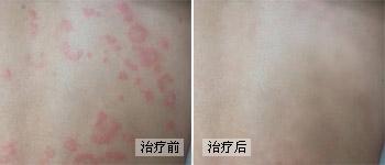 治疗荨麻疹有什么好的方法