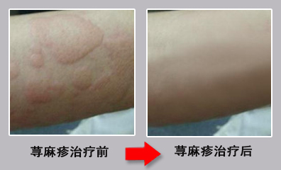 导致荨麻疹发病的原因是什么