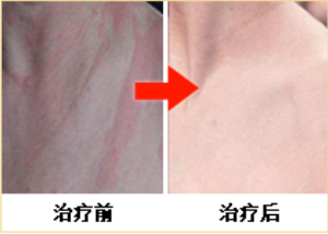 荨麻疹案例，荨麻疹病因，荨麻疹治疗方法_重庆荨麻疹医院