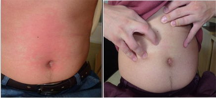 荨麻疹案例,荨麻疹病因,荨麻疹治疗方法_重庆荨麻疹医院