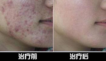 重庆治疗青春痘_痘痘_痘印痘坑_痤疮最好的医院（重庆祛痘最好的医院）青春痘案例图_祛痘效果图_重庆治疗青春痘医院