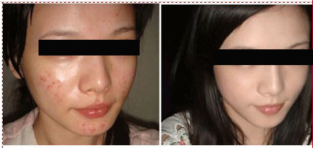重庆治疗青春痘_痘痘_痘印痘坑_痤疮最好的医院（重庆祛痘最好的医院）青春痘案例图_祛痘效果图_重庆治疗青春痘医院