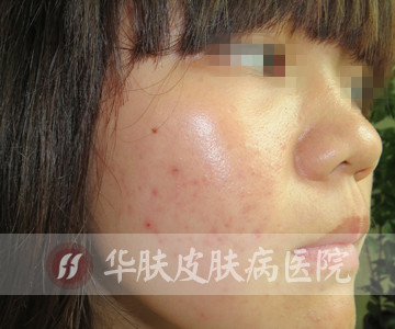 重庆治疗青春痘_痘痘_痘印痘坑_痤疮最好的医院（重庆祛痘最好的医院）青春痘案例图_祛痘效果图_重庆治疗青春痘医院