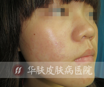 重庆治疗青春痘_痘痘_痘印痘坑_痤疮最好的医院（重庆祛痘最好的医院）青春痘案例图_祛痘效果图_重庆治疗青春痘医院