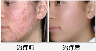 重庆治疗青春痘_痘痘_痘印痘坑_痤疮最好的医院（重庆祛痘最好的医院）青春痘案例图_祛痘效果图_重庆治疗青春痘医院