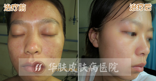 重庆治疗青春痘_痘痘_痘印痘坑_痤疮最好的医院（重庆祛痘最好的医院）青春痘案例图_祛痘效果图_重庆治疗青春痘医院