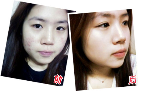 发青春痘的原因有哪些