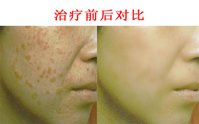 扁平疣的日常护理方法有哪些呢?