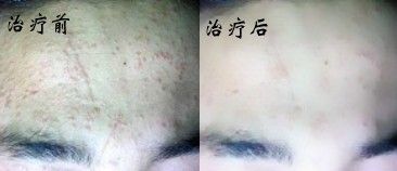 扁平疣的日常护理方法有哪些呢?