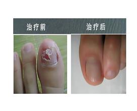 治疗灰指甲常用的方法有哪些