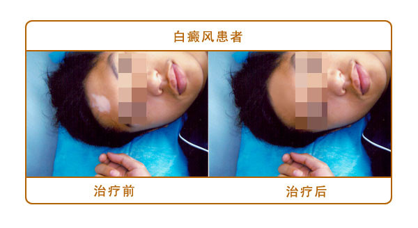 怎么防止白癜风的继续扩散
