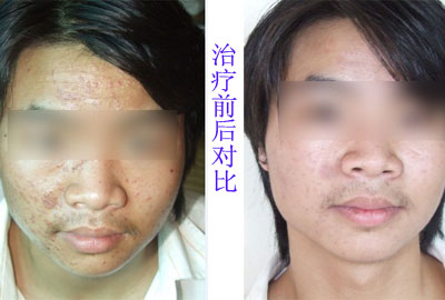 引发扁平疣的原因有哪些呢