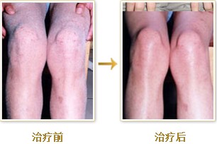 鱼鳞病都有哪些危害