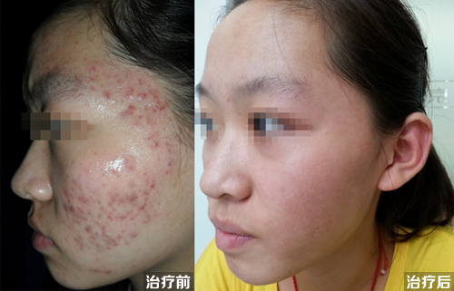 看痘痘重庆最好的皮肤科医院