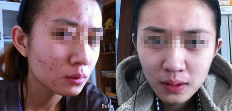 夏季青春痘要怎么护理最好