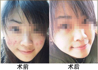 青春痘的治疗四大步骤