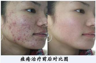 重庆治疗青春痘_痘痘_痘印痘坑_痤疮最好的医院（重庆祛痘最好的医院）青春痘案例图_祛痘效果图_重庆治疗青春痘医院