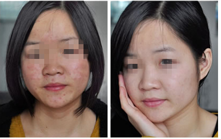 治疗皮肤病重庆华肤医院怎样