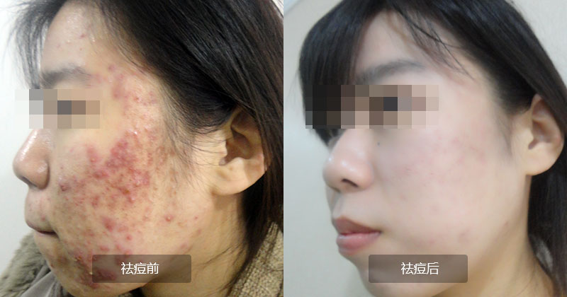重庆治疗青春痘_痘痘_痘印痘坑_痤疮最好的医院（重庆祛痘最好的医院）青春痘案例图_祛痘效果图_重庆治疗青春痘医院