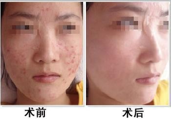 在重庆看痘痘需要好多钱