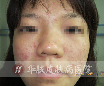 去重庆华肤看看痘痘 是怎么收费的
