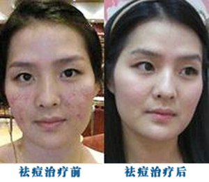 成年患者的疗效远不及青春期患者