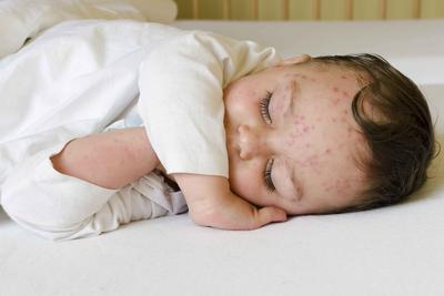 重庆皮肤医院解读湿疹是由什么引起的 湿疹的导致因素